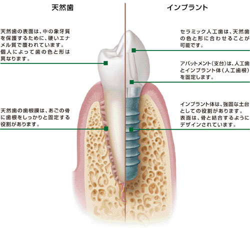 天然歯とインプラントの違い