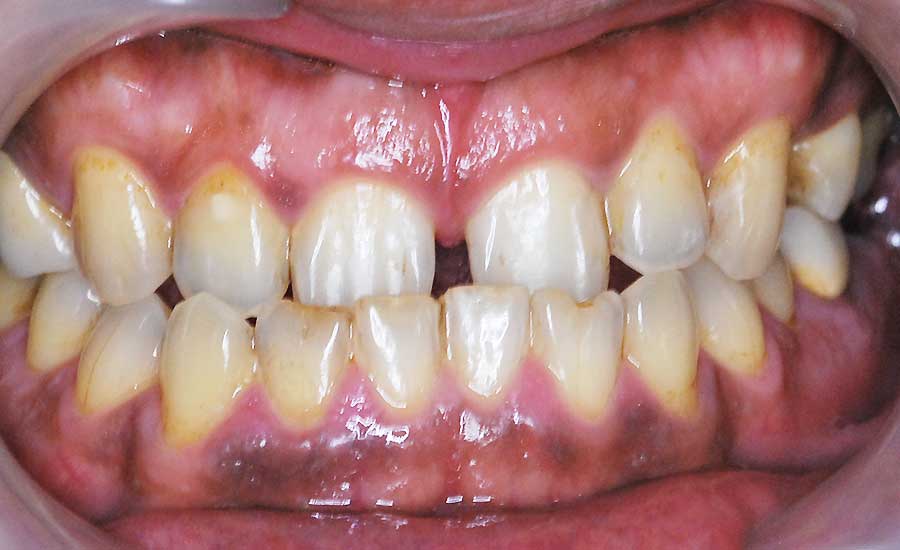 ガムピーリング施術前は歯茎が黒ずんでいます。