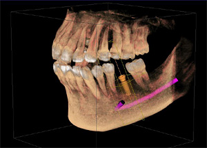 椎名町 原歯科医院では歯科用CTを利用してインプラント治療のシミュレーションを行ってから施述をすることが可能です